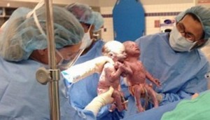 gemeas nascem de mao dada