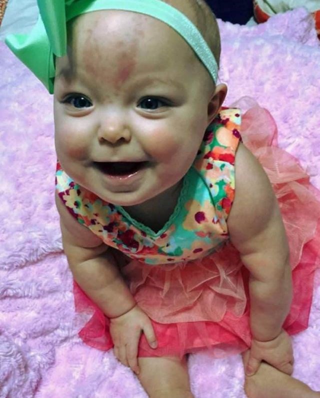 bebe-nasceu-lingua-gigante-ja-consegue-sorrir-3