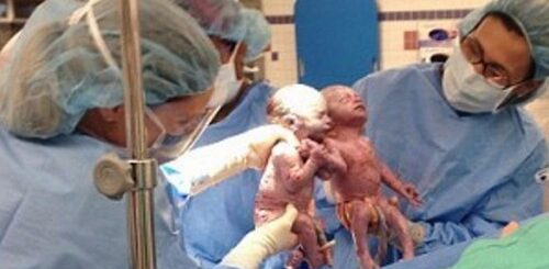 gemeas nascem de mao dada