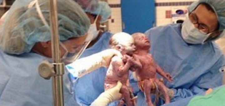 gemeas nascem de mao dada